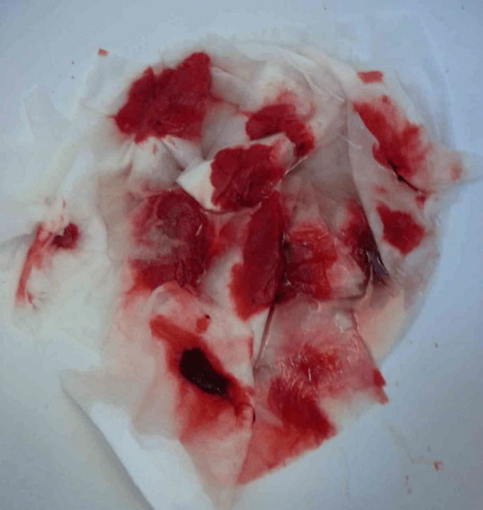 Sangrado con hemorroides