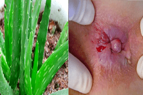 aloe para o tratamento das hemorroides